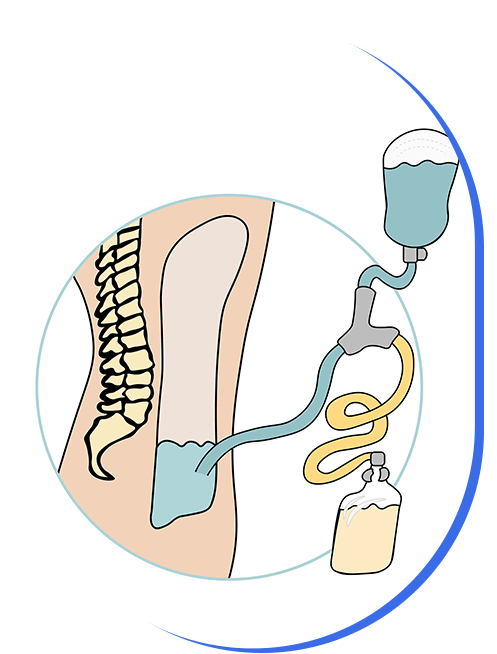 dialisis-peritoneal.png