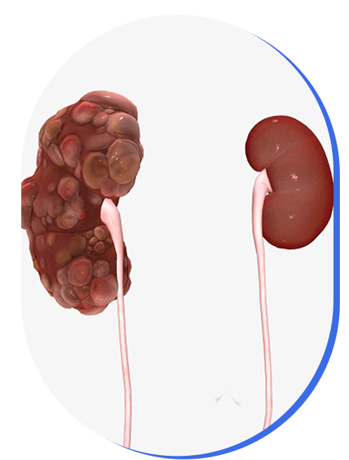 evaluacion-pre-trasplante-renal.png