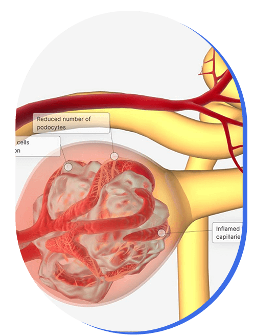 tratamiento-de-glomerulonefritis.png
